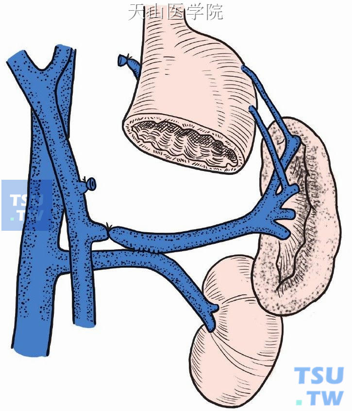 脾静脉远侧段直接与肾静脉行侧侧吻合术