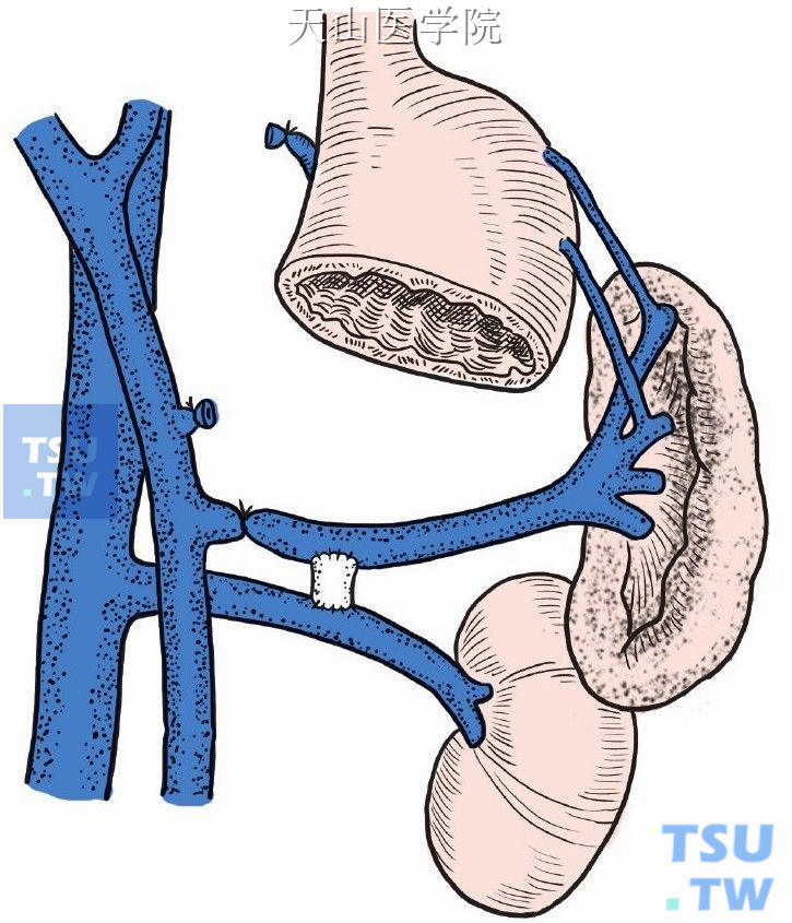 图11-2-78　脾静脉远侧段直接与肾静脉行侧侧吻合术  结扎脾静脉近侧端，在其远侧段与肾静脉之间行人造血管“H”形桥式分流术