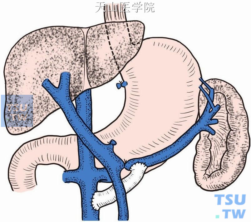 图11-2-79　  结扎脾静脉近侧端，在其远侧段与下腔静脉之间行人造血管“H”形桥式分流术