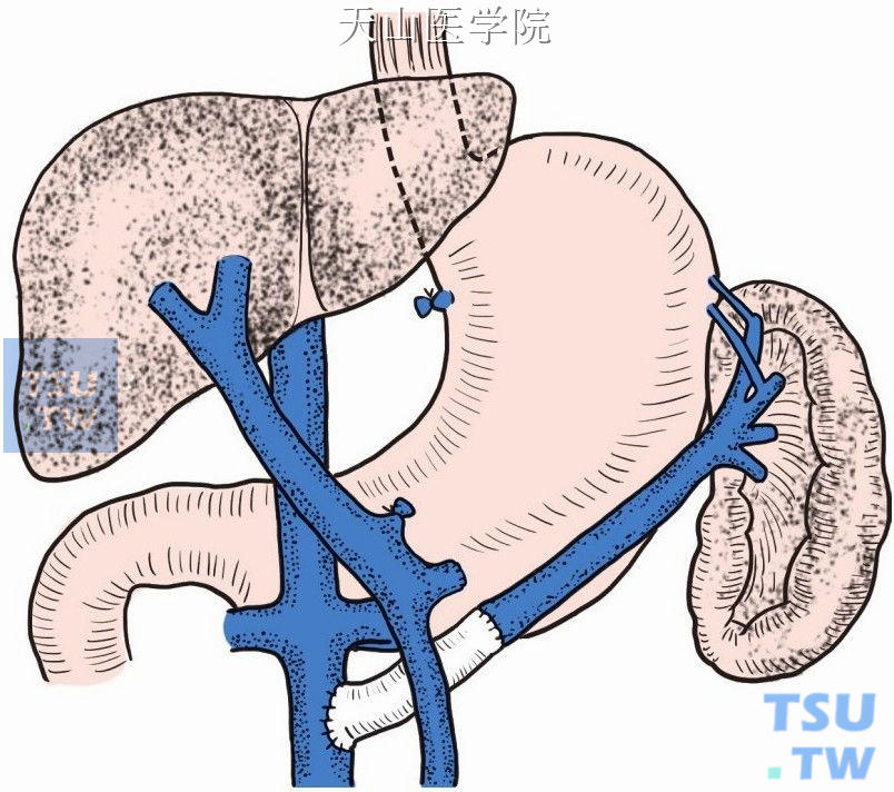 也可切断脾静脉，缝扎近肝端，然后将脾静脉远肝端与下腔静脉行端端“H”形桥式分流术