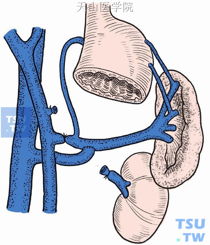 远端脾肾分流术的多种改良术式