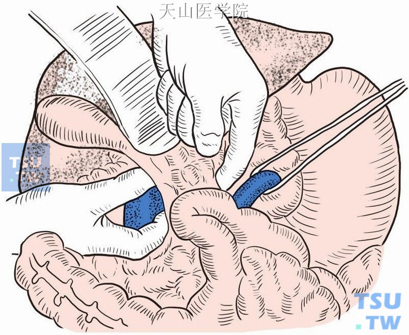 在胰腺头部上缘和肝十二指肠韧带后面分离出至下腔静脉的隧道