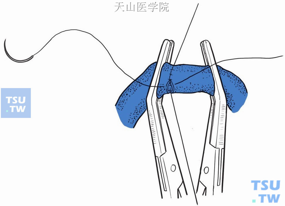 胃冠状静脉（胃左静脉）与自体大隐静脉或人造血管端端吻合（前壁）