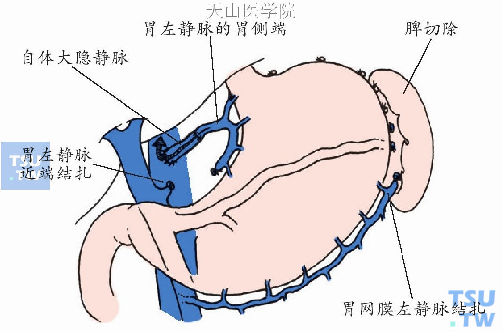 胃左静脉与下腔静脉间置自体大隐静脉桥式分流术