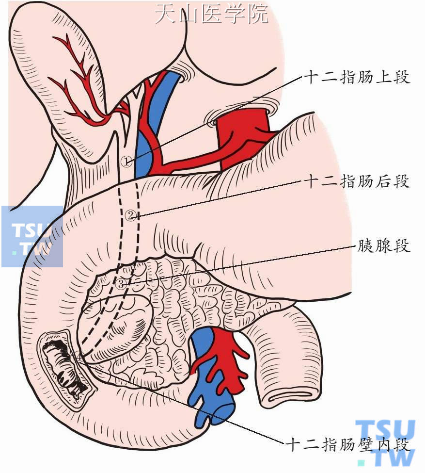 胆总管分段