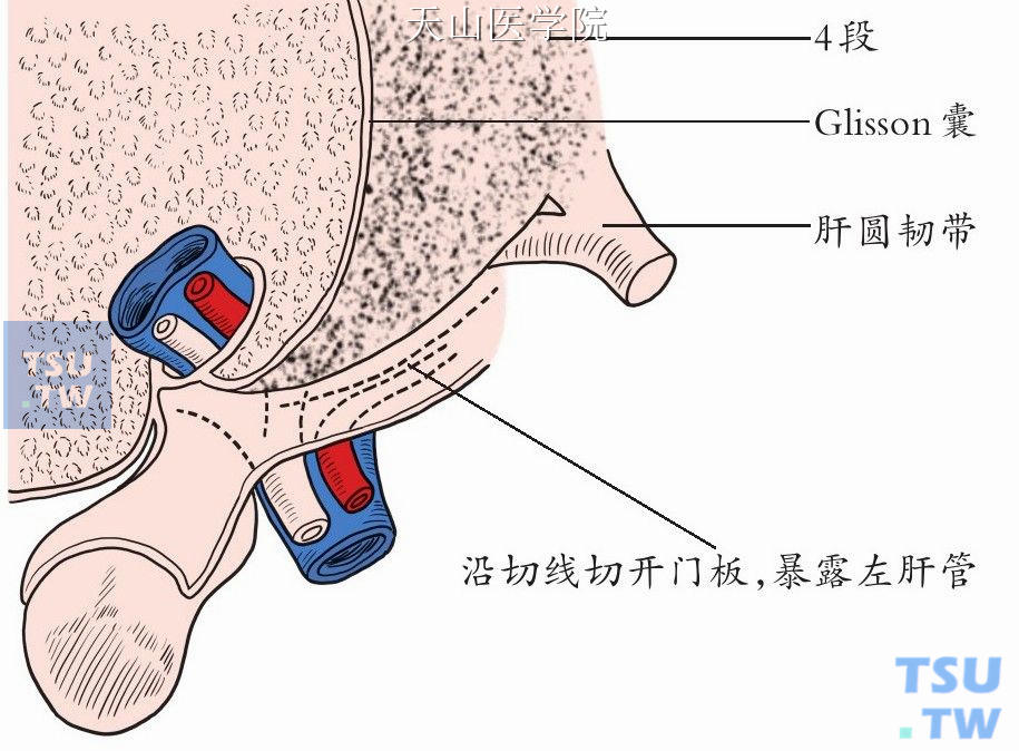 解剖肝门板