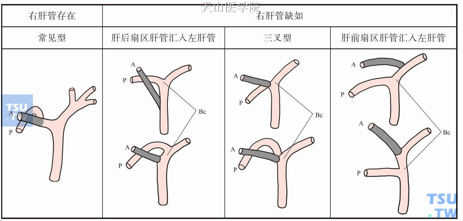 右肝管的解剖学变异