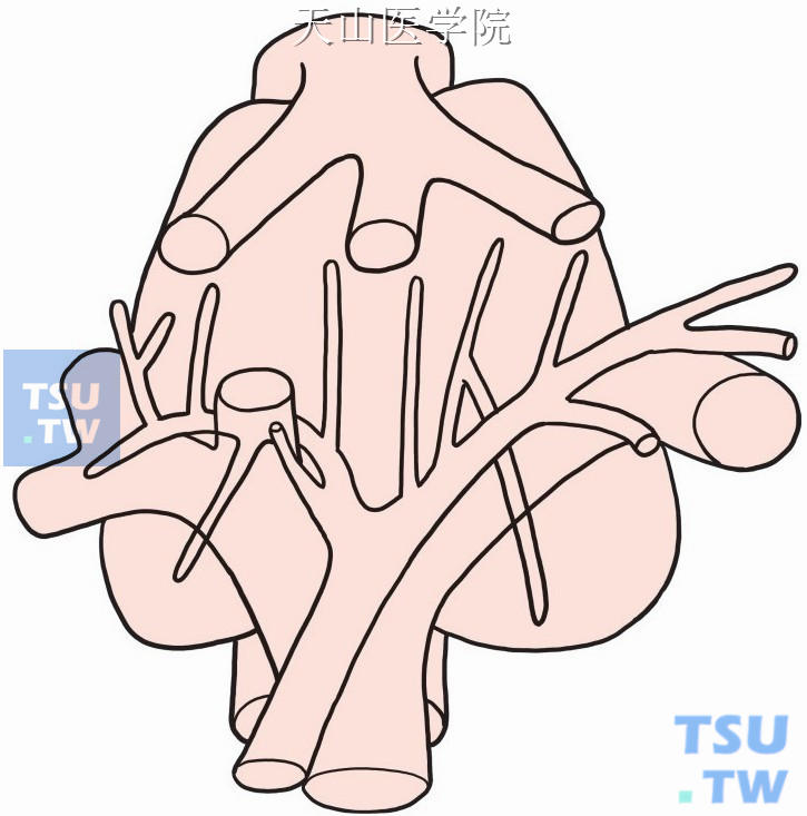 尾状叶胆管引流的常见类型