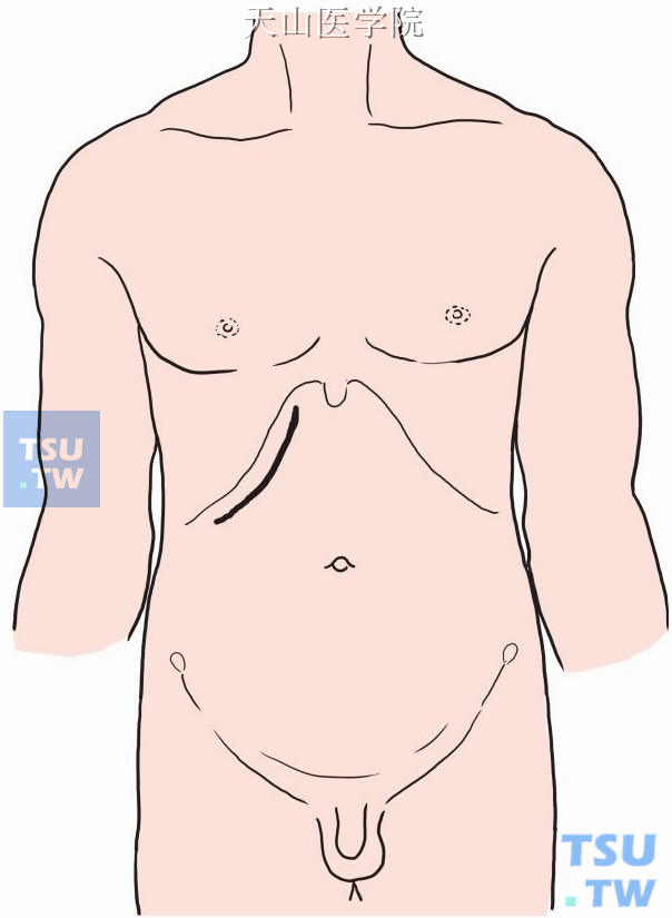 取右上腹肋缘下斜切口，自腹中线左侧1cm，沿肋弓平行线下2～3cm向右切开腹壁各层