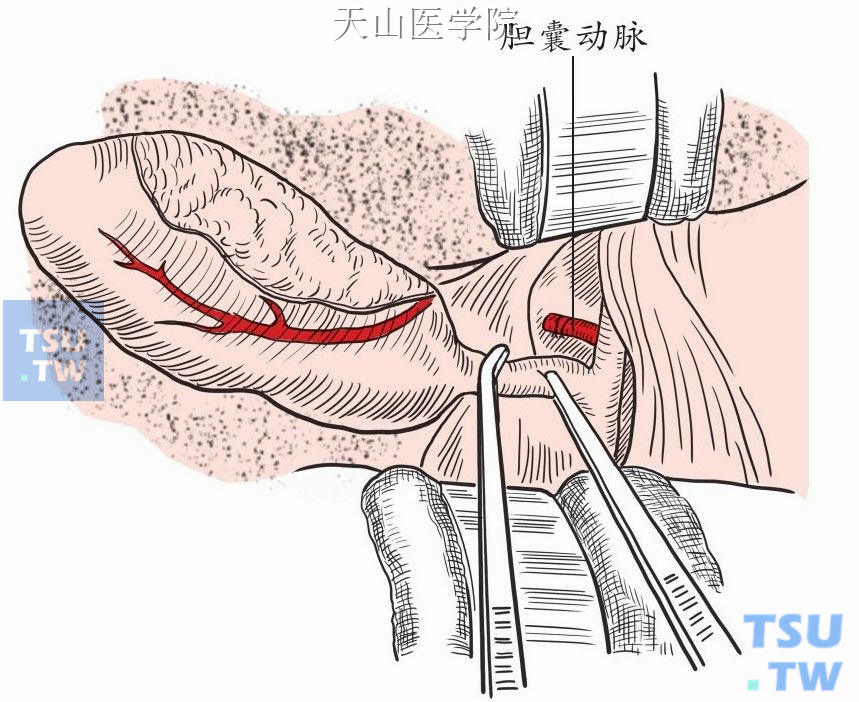 胆囊动脉离断结扎