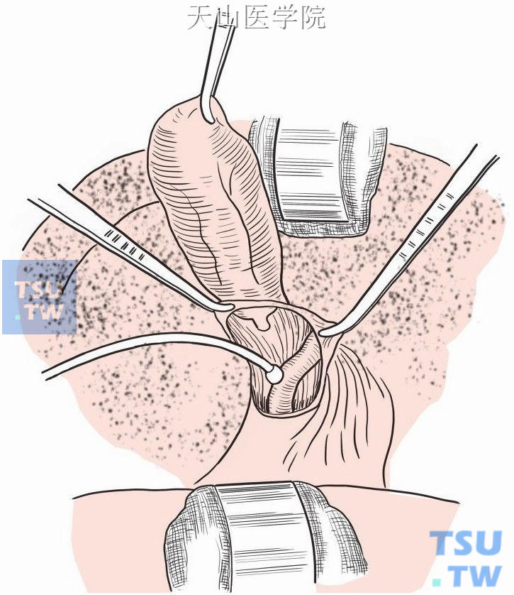 经胆囊管插入造影用导管