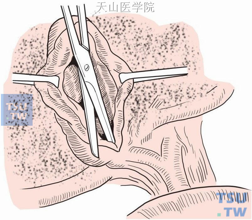 若胆囊炎症很重、胆囊三角显示不清、胆囊和胆囊窝之间分离出血较多，则可剖开胆囊，将胆囊窝部位的粘膜剥离、切除或用碘酊涂擦使之破坏