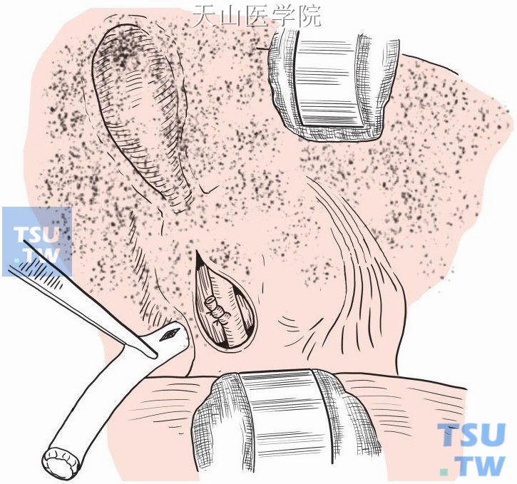 一般放置引流管于Winslow孔处，另戳口引出，固定于腹壁