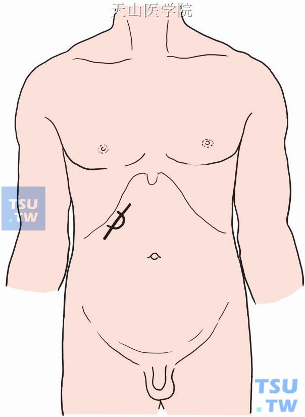 如触及肿大的胆囊，可以以此为标志，行右侧肋缘下斜切口