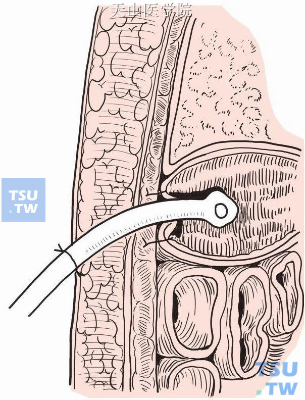 导管戳口引出，固定于腹壁