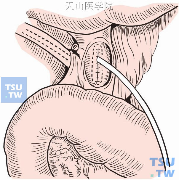 胆总管探查引流术