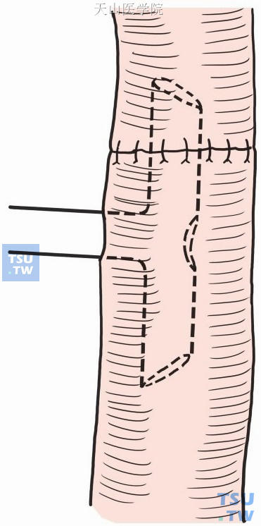 吻合口远侧胆管壁切开放置“T”形管