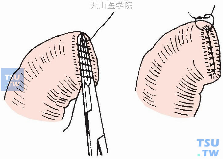 远侧断端用双层缝合关闭