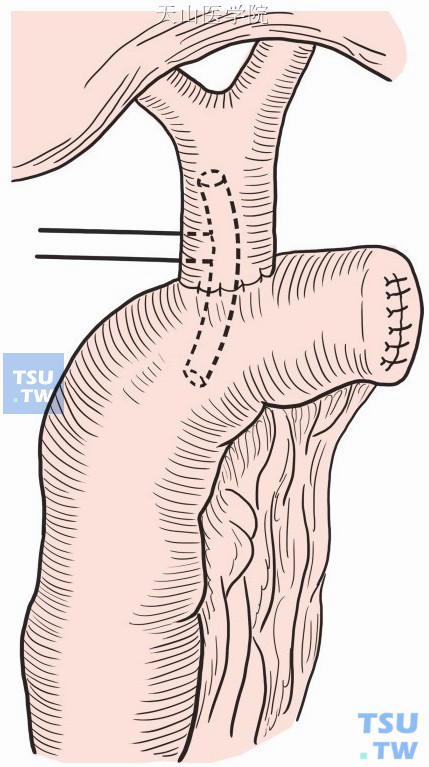 胆总管空肠吻合术图谱图片