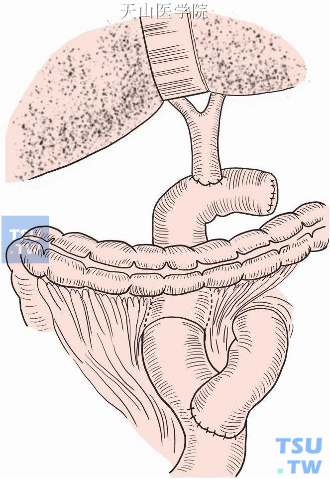 胆总管空肠吻合术图解图片