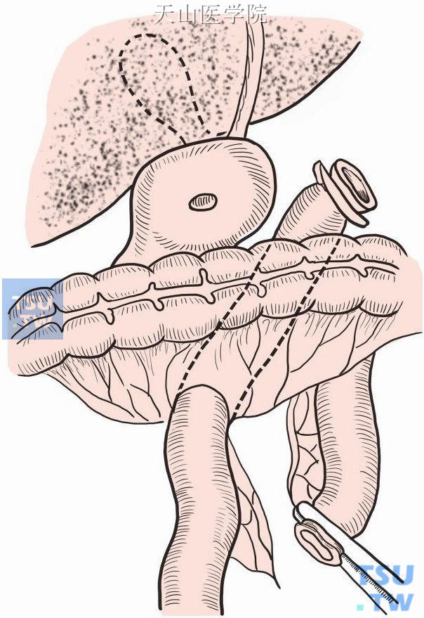 胆总管空肠吻合术图谱图片