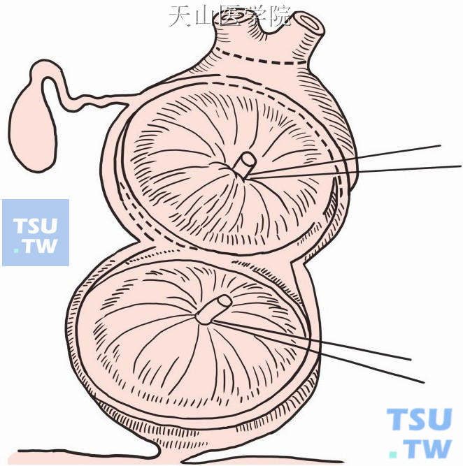 切除囊肿内膜