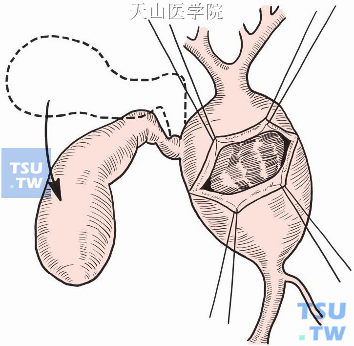 如果扩张的胆总管炎症明显，粘膜与外膜的界限平面不易剥离，可先行切除胆囊，循胆囊管找到粘膜与外膜间的解剖平面，以此进行胆管粘膜的剥离和切除