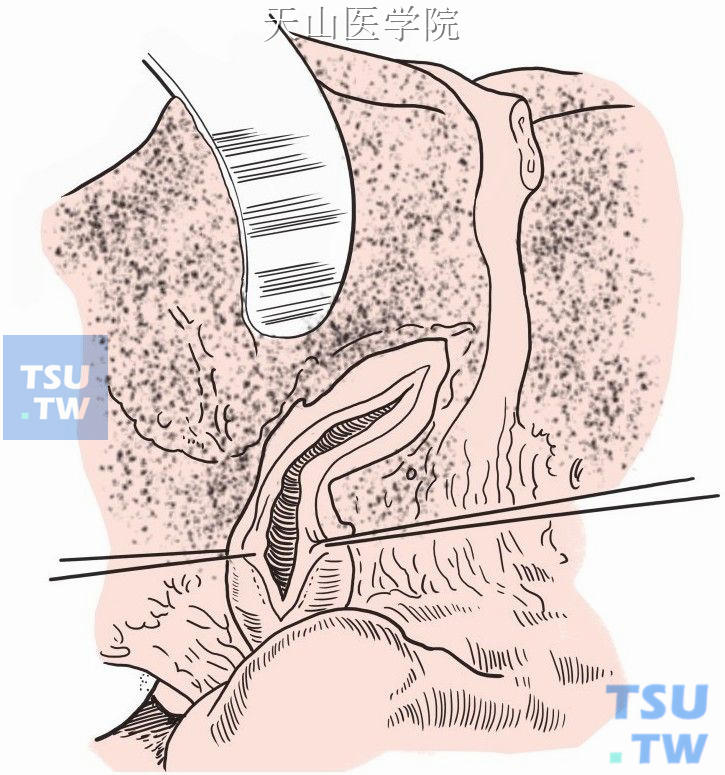 切开肝总管环状狭窄并向左肝管切开至横部
