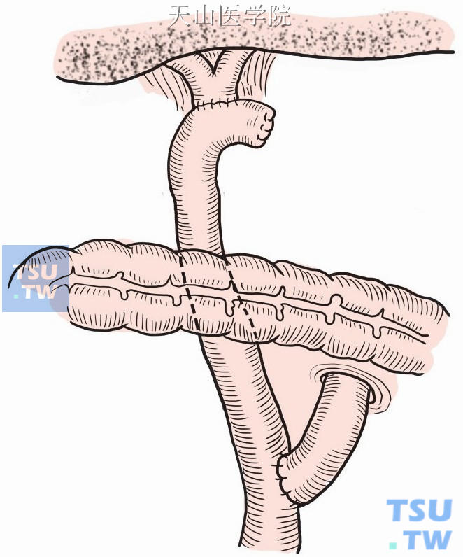 胆总管空肠吻合术图谱图片