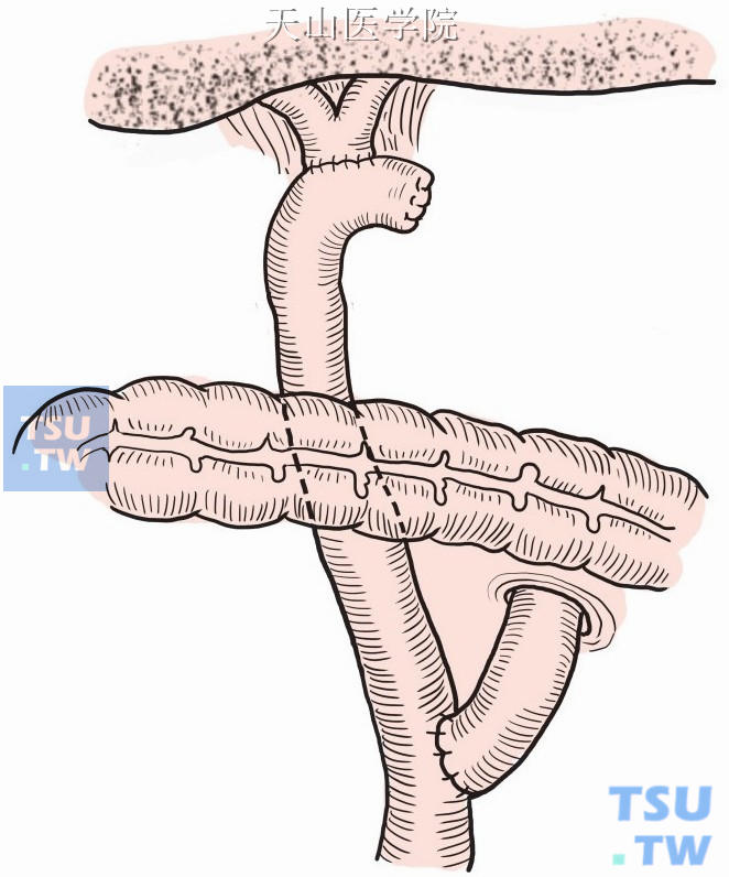 胆总管空肠吻合术图解图片