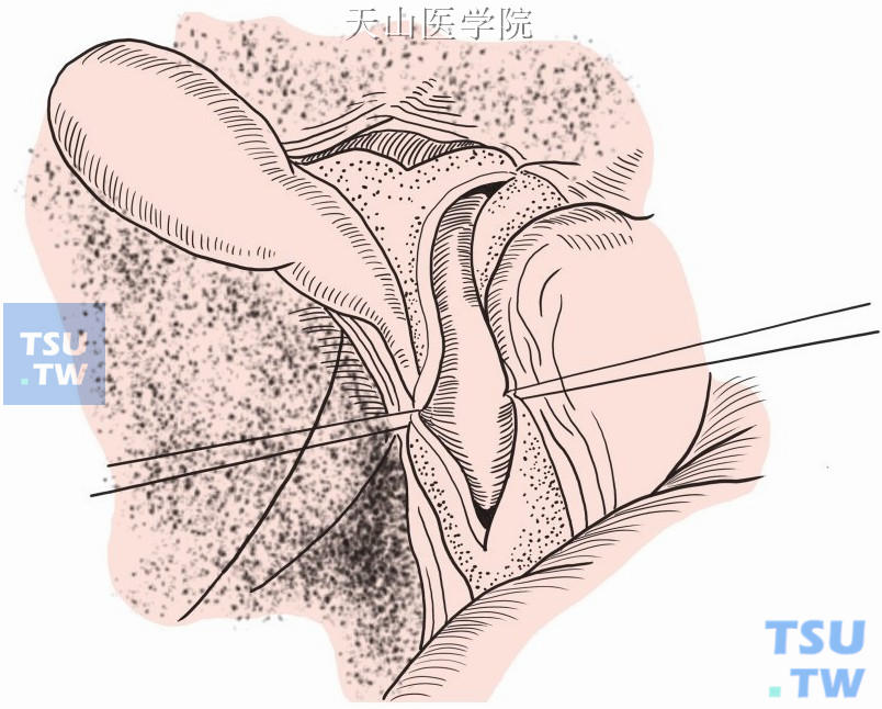 胆管切口两侧缝合牵引