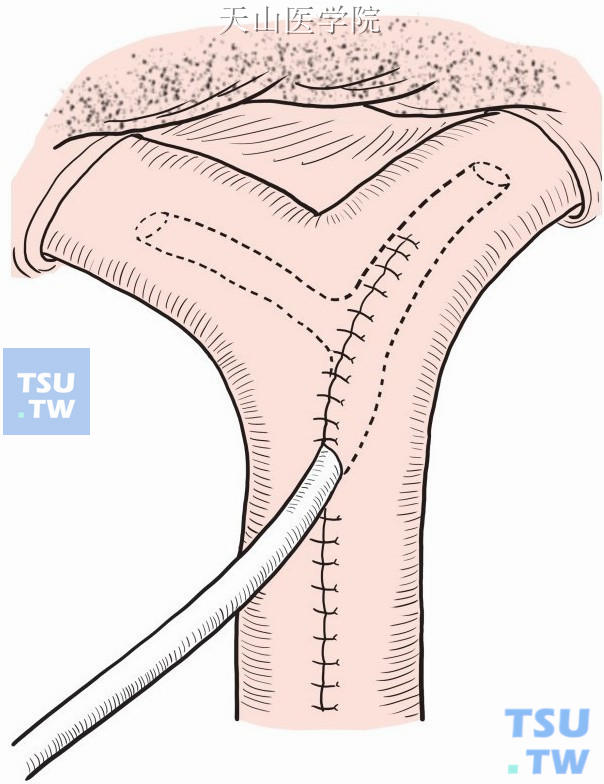 左右肝管内留置“T”形管