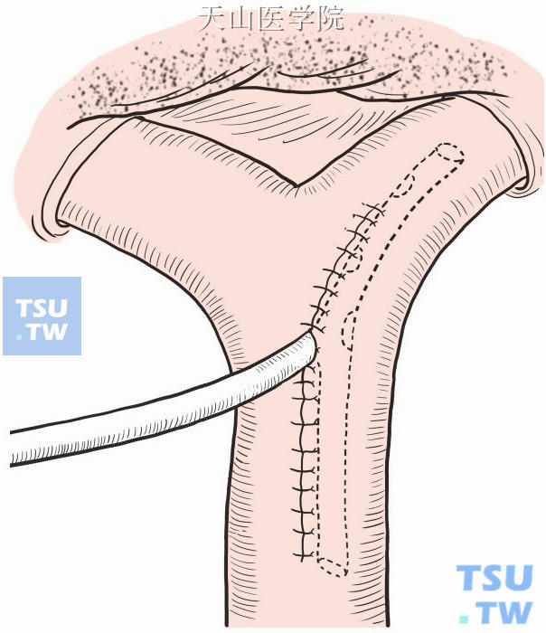 左肝管内留置“T”形管