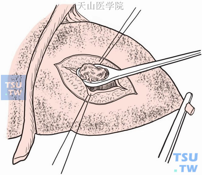 清除肝左外叶内结石