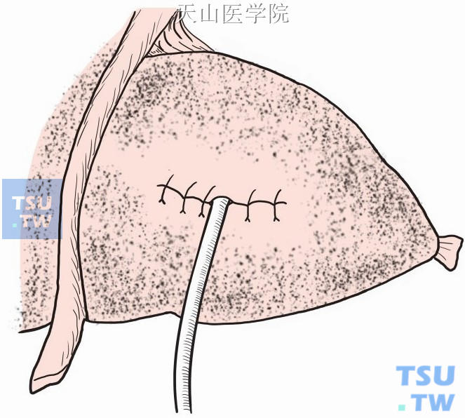 肝内胆管的切口放入“T”形管