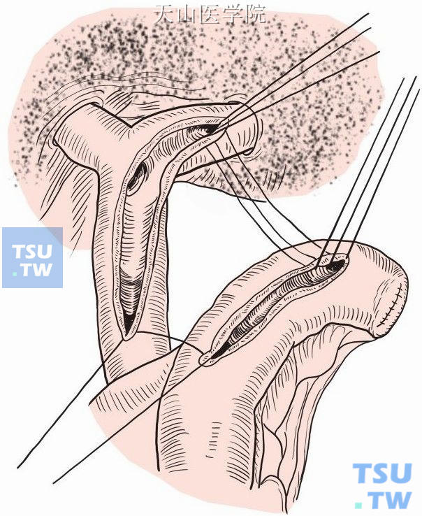 胆总管空肠吻合术图解图片
