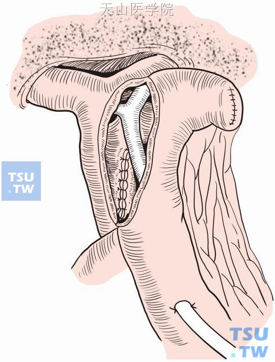 “T”形管两短臂放至左右肝管，长臂通过空肠襻引出