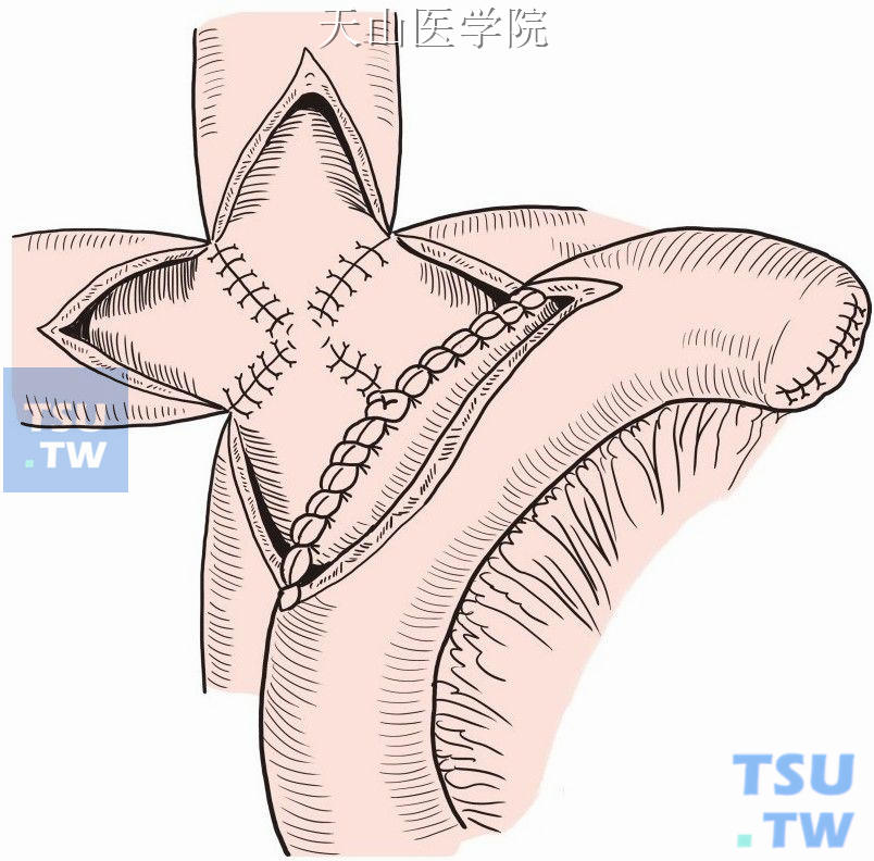 胆总管空肠吻合术图谱图片