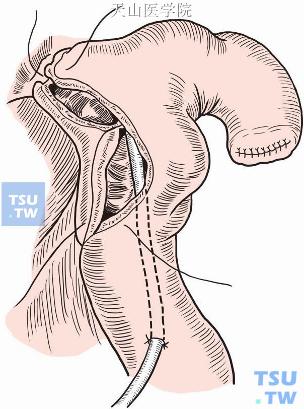 肝管内放置“T”形管