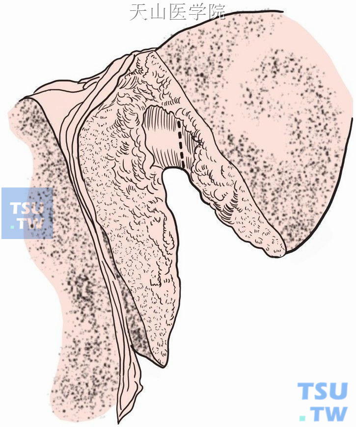 肝内胆管的切断部位