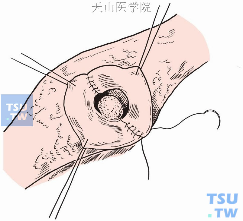 肝内胆管空肠吻合术