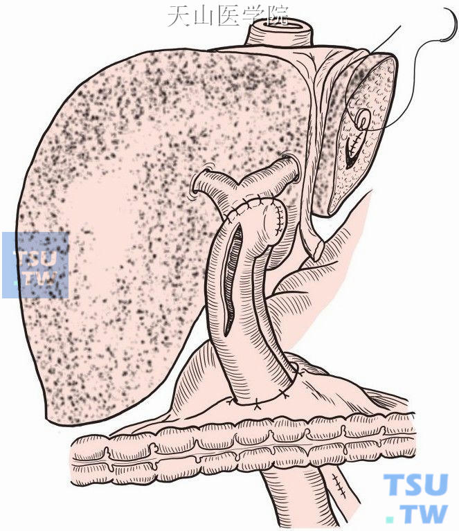 肝内胆管结石的联合手术
