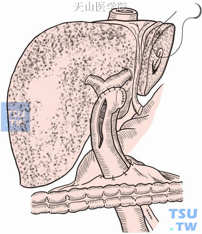 左外叶切除，经肝管残端取石，胆总管空肠Roux-en-Y吻合