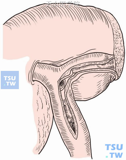 左肝管前面切开，与胆总管上的切口连接，通过此切口在直视下清除肝左内叶、尾状叶胆管内结石