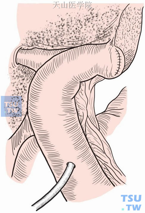 左肝管胆总管空肠侧侧吻合