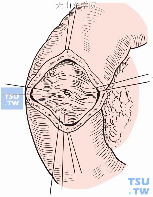 辨认十二指肠大乳头的胆管开口