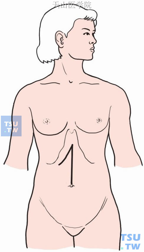 取右侧肋缘下斜切口或正中切口。进腹后仔细探查，特别是胆管系统，必要时行术中造影，确认胆总管上端及肝内外胆管无狭窄和梗阻