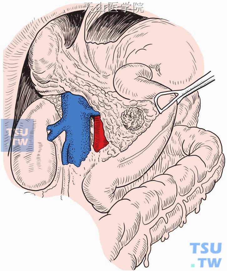 Kocher切口打开十二指肠降部外侧腹膜