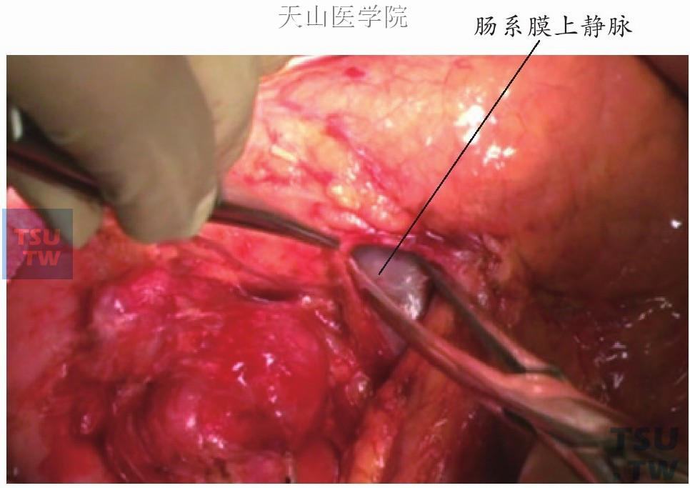 胰腺颈部下缘解剖显露出肠系膜上静脉