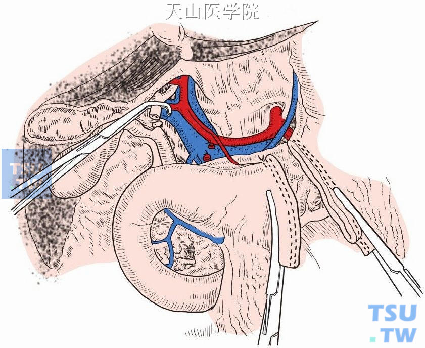 远端胃切除